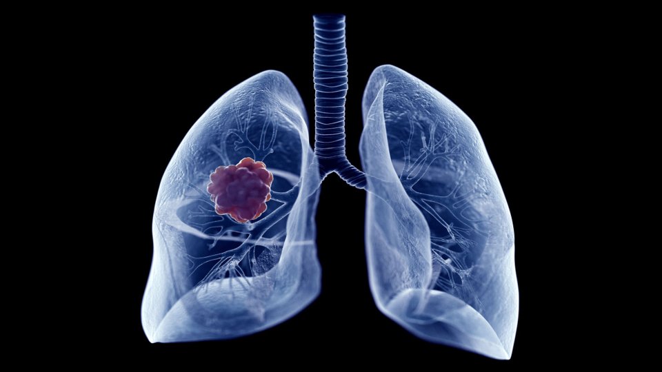 Akciğer Kanseri Nedir? Akciğer Kanseri Belirtileri ve Tedavi Yöntemleri
